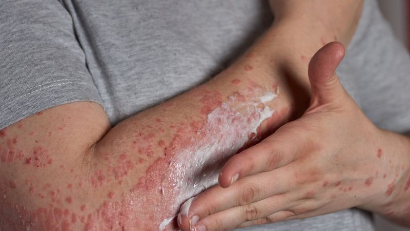 Após exames, 17 casos foram confirmados de catapora e um suspeito de monkeypox | Bnews - Divulgação Reprodução Freepik